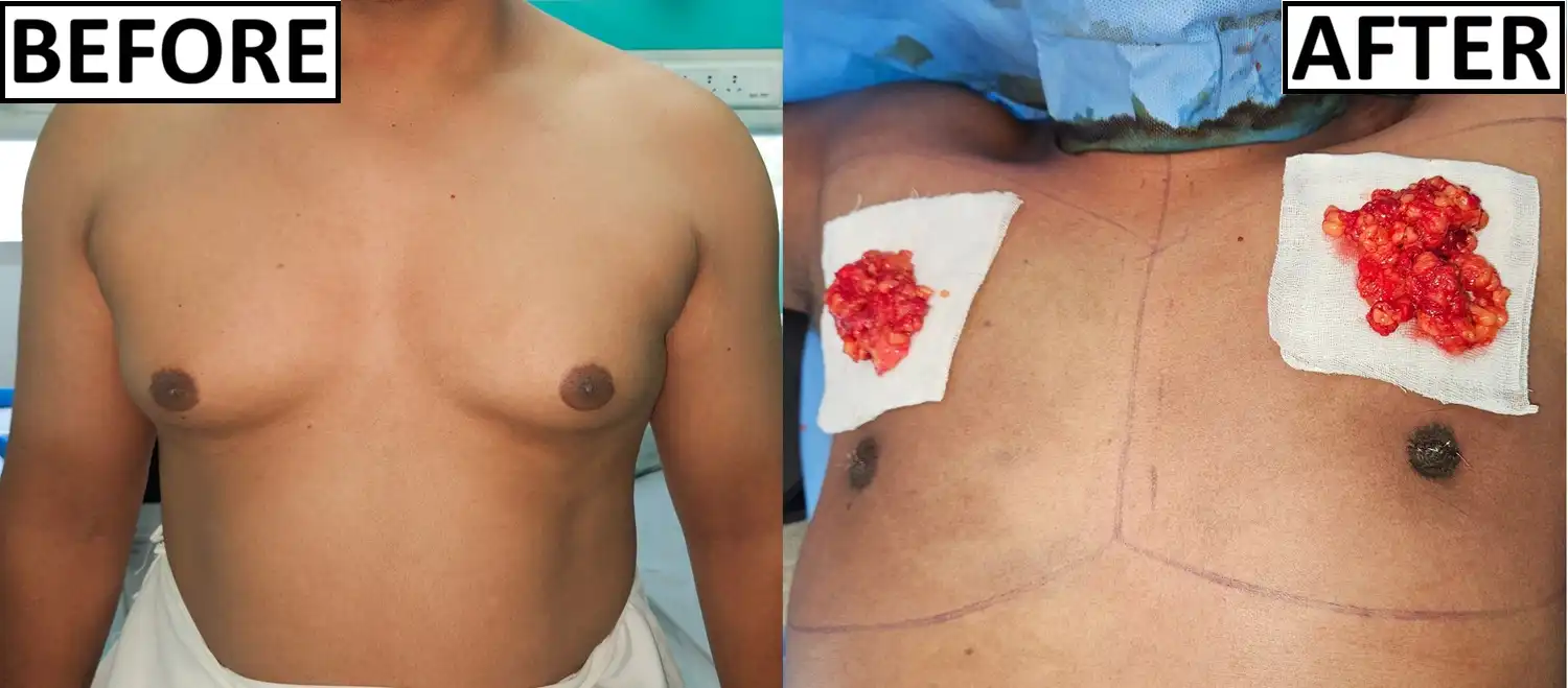 Operative photo of gynaecomastia surgery