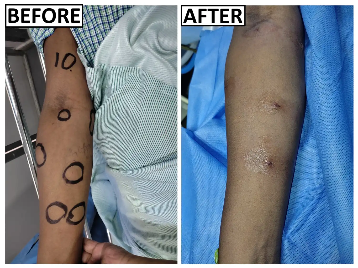 Before and after lipoma recovery by Dr. Amrika Seshadri