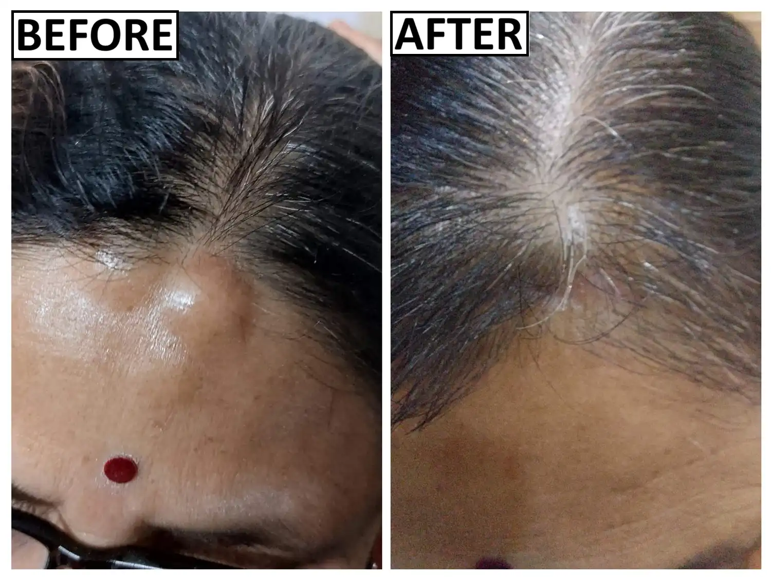 Before and after lipoma removal by Dr. Amrika Seshadri