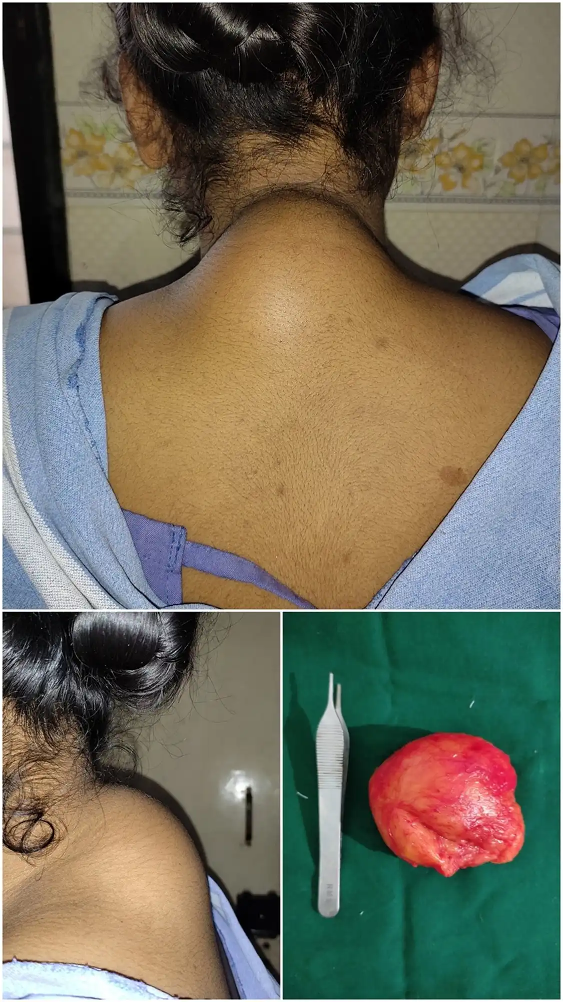 Before and after lipoma structure by Dr. Amrika Seshadri