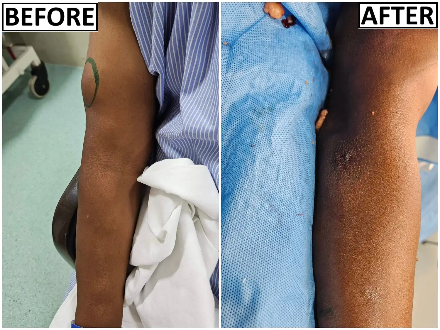 Before and after lipoma treatment by Dr. Amrika Seshadri