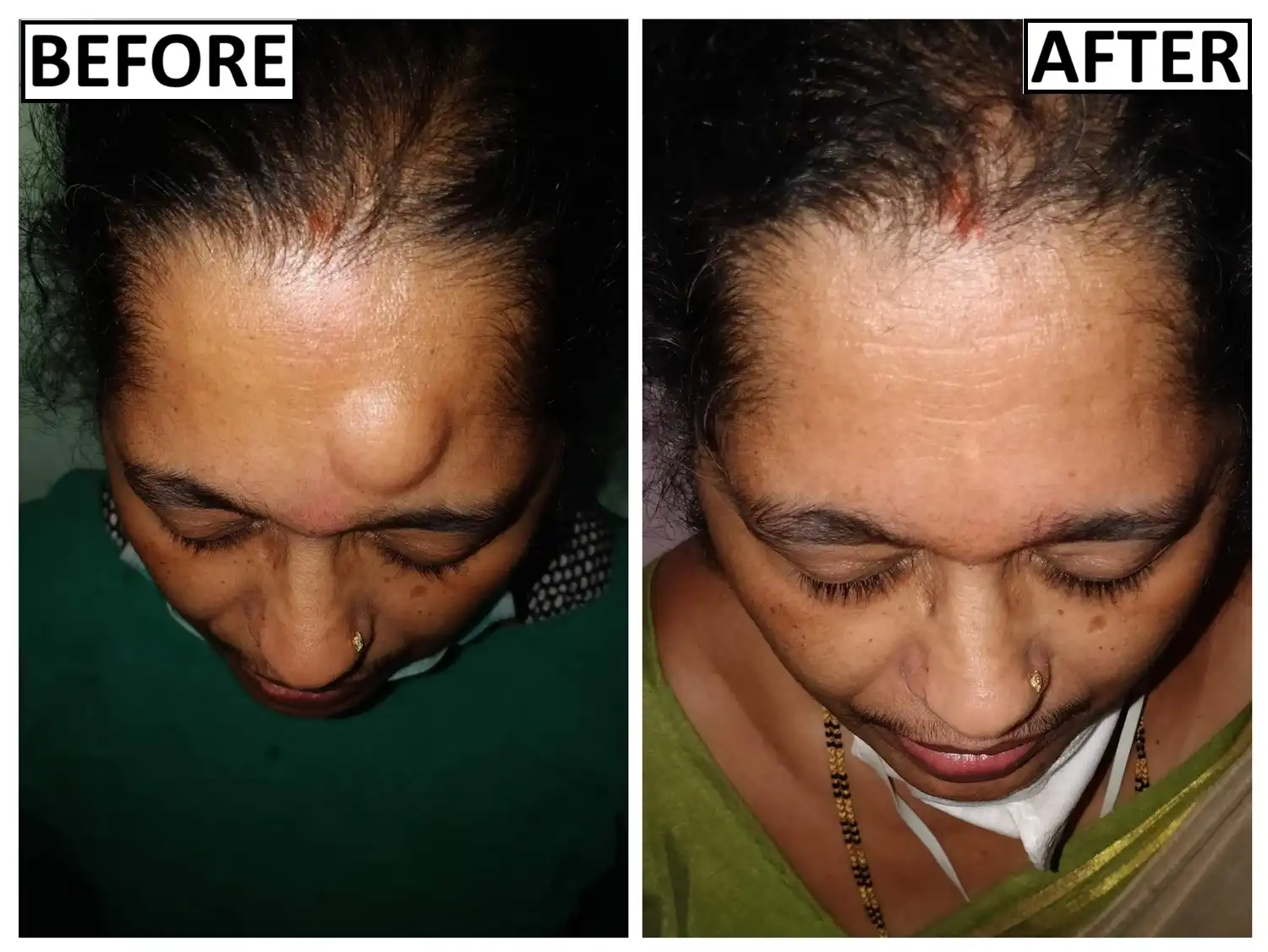 Before and after scarless lipoma removal by Dr. Amrika Seshadri