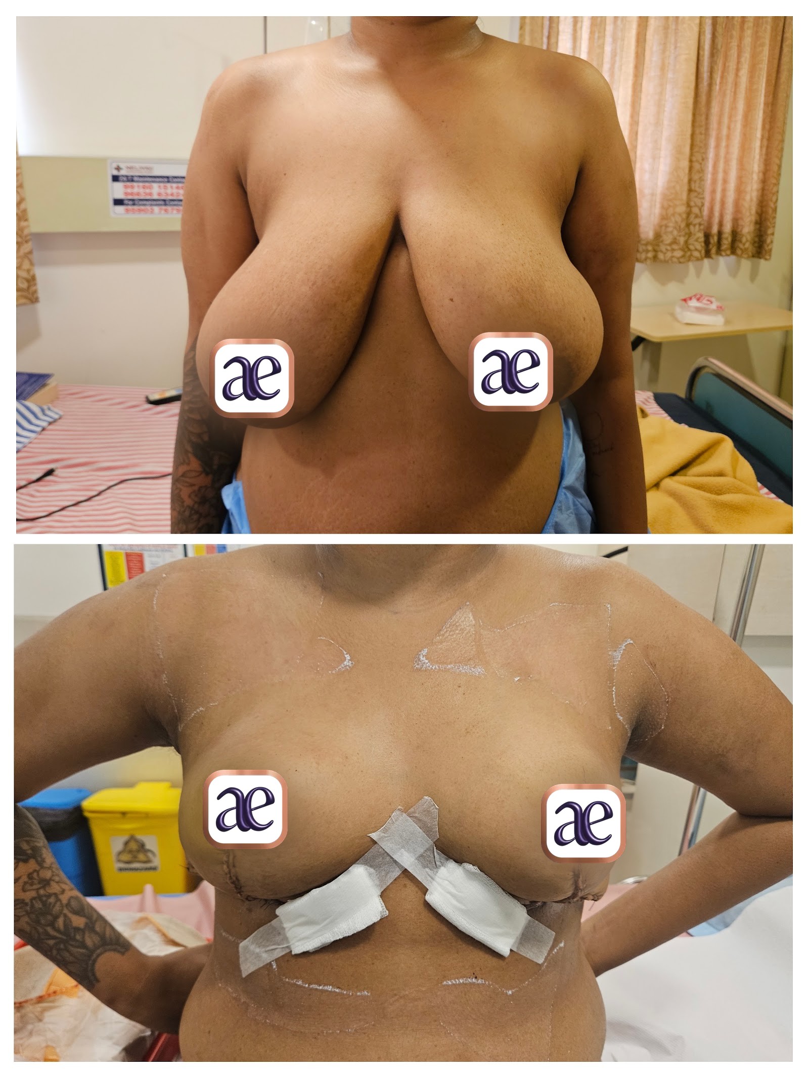 Breast reduction & lift — featured before and after result at Dr. Amrika's Aesthetics, Bangalore