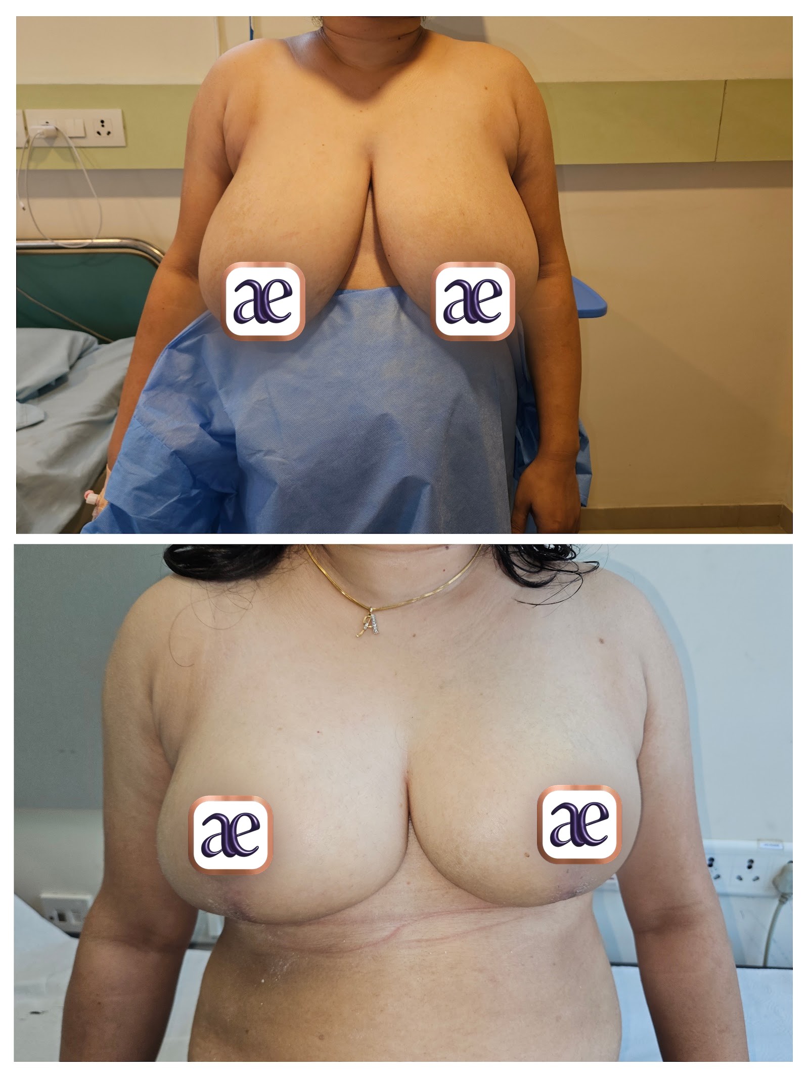 Breast reduction & lift before and after — case 2, Dr. Amrika's Aesthetics, Bangalore