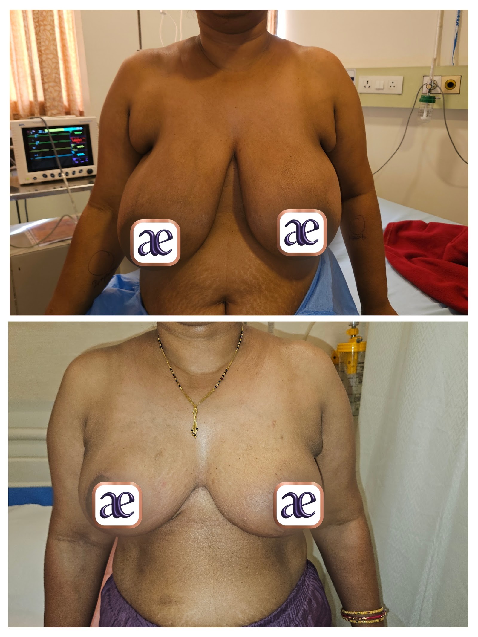 Breast reduction & lift before and after — case 3, Dr. Amrika's Aesthetics, Bangalore